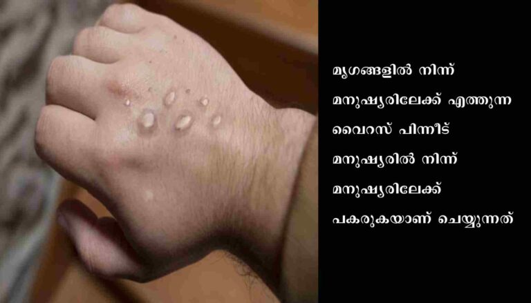 മങ്കിപോക്‌സ്‌ ഒരു ലൈംഗിക രോഗമോ?